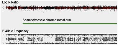 Genome-wide copy number variant screening of Saudi schizophrenia patients reveals larger deletions in cases versus controls